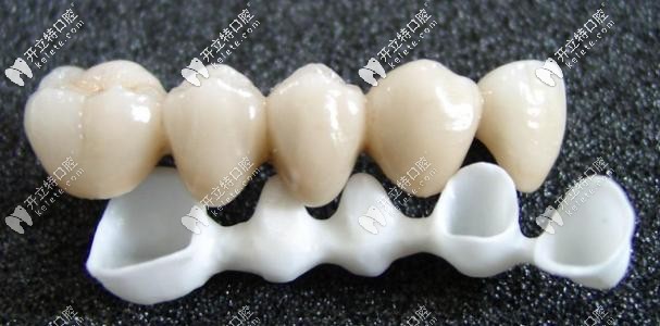 杜塞拉姆全瓷牙怎么樣?這款德國氧化鋯全瓷牙價格/優(yōu)點在這