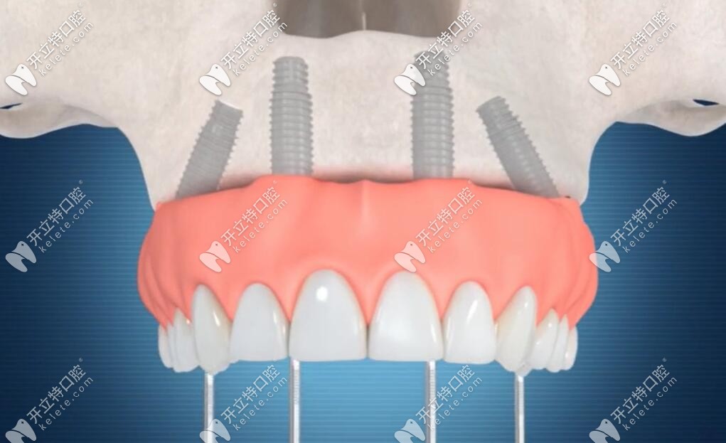種植牙戴牙冠的步驟