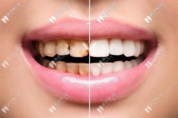 牙齒美白效果對(duì)比圖
