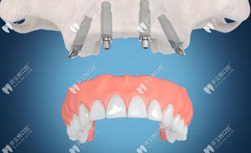 植入植體后戴牙冠過(guò)程
