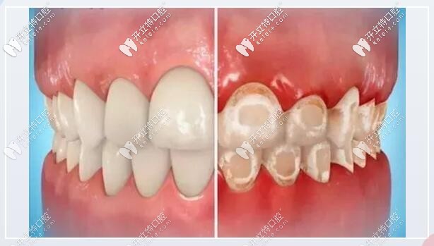 不建議長期使用小蘇打刷牙 ，會損害牙釉質(zhì)，破壞牙本質(zhì)。