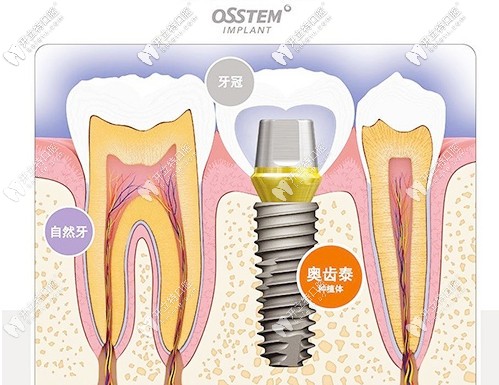 韓國奧齒泰穩(wěn)固性極高