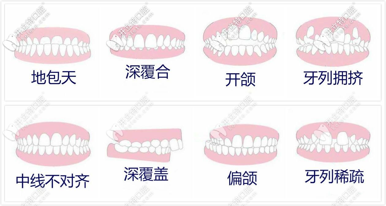 牙齒矯正適應(yīng)癥 牙齒矯正適應(yīng)癥