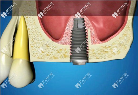 上頜竇內(nèi)提升術(shù)參考價(jià)格