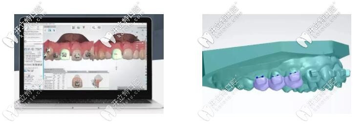 藍(lán)天口腔的智能正畸粘接導(dǎo)板技術(shù)