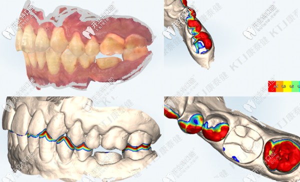 數(shù)字化口掃取模