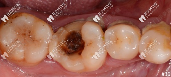 牙齒大面積缺損，用康泰健格萊美瓷嵌體修復(fù)案例分享