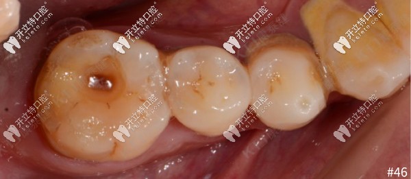 46牙齒缺損檢查