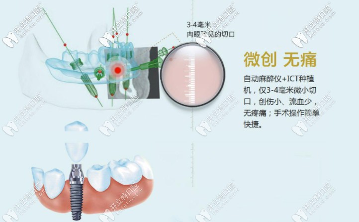 微創(chuàng)即刻種植牙技術(shù) 微創(chuàng)即刻種植牙技術(shù)