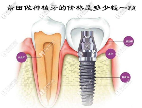 莆田做種植牙的價(jià)格是多少錢(qián)一顆