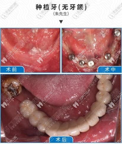 藍(lán)天口腔醫(yī)院種植牙案例