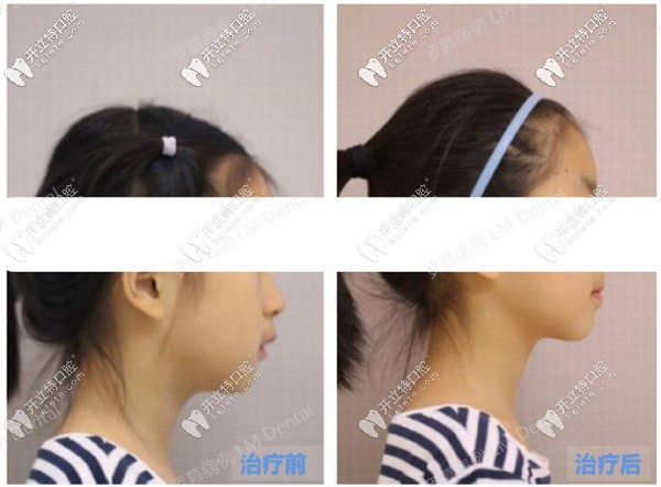 兒童深覆合矯正前后臉型對(duì)比