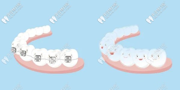  門牙不齊想拔了做種植牙?來聽牙醫(yī)說說門牙長歪的矯正方法
