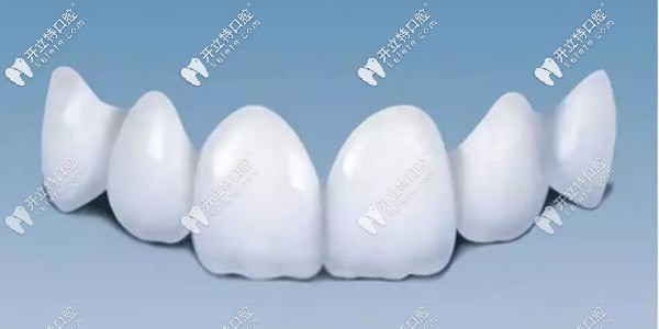 門牙長歪的矯正方法--美容冠