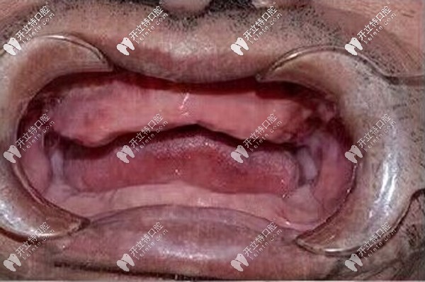 陳叔叔全口種植牙前 陳叔叔全口種植牙前