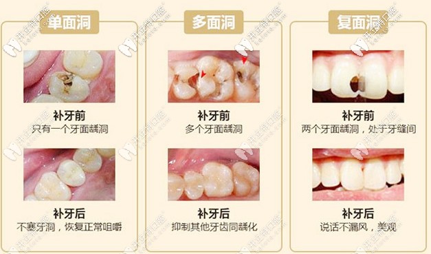 補(bǔ)牙前后對比圖