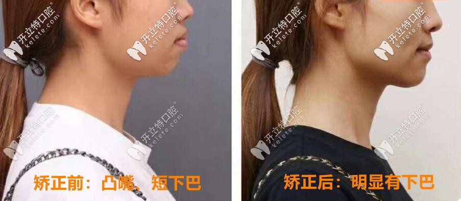 矯正前后對(duì)比照片：明顯有下巴，側(cè)顏好看