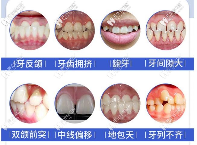 想知道重慶時代天使矯正價格嗎？世紀(jì)美奧口腔活動價19800