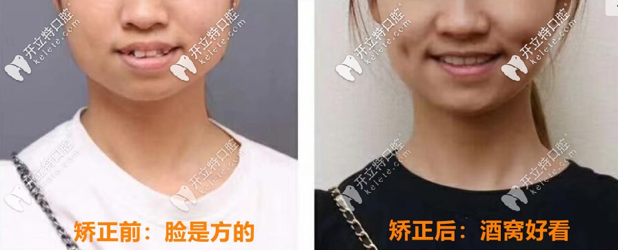 00后妹子：輕度骨性凸嘴2年矯正完成