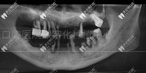 種牙前的口腔檢查