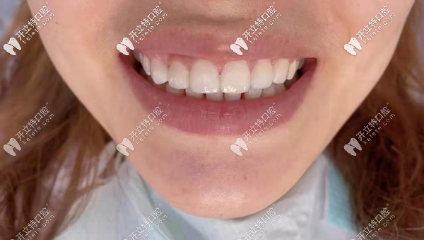 做了美加全瓷牙貼面后效果