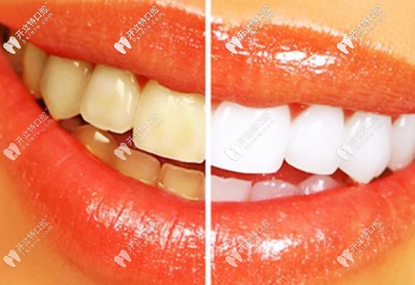 廣州市的牙齒修復(fù)價(jià)格