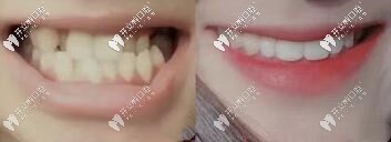 黃醫(yī)生：地包天、反頜復雜案例矯正