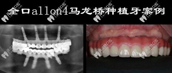 馬瀧齒科全口allon4馬龍橋種植牙案例圖片