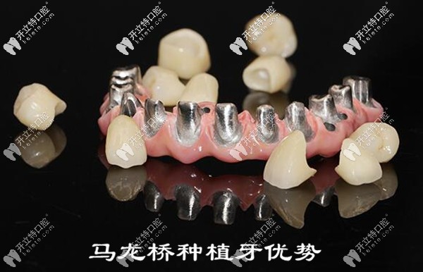 馬龍橋種植牙的優(yōu)缺點(diǎn)