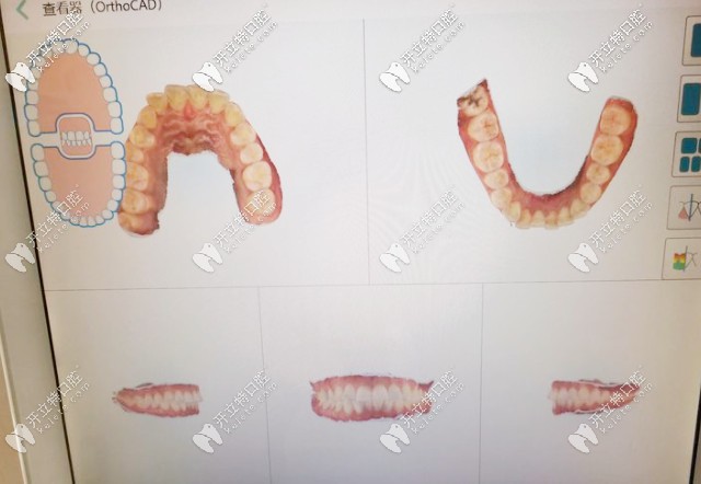 矯正口掃儀器可預(yù)見(jiàn)矯正結(jié)果