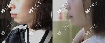 深覆合、齙牙顧客—拔牙7顆做的美國進(jìn)口自鎖金屬托槽