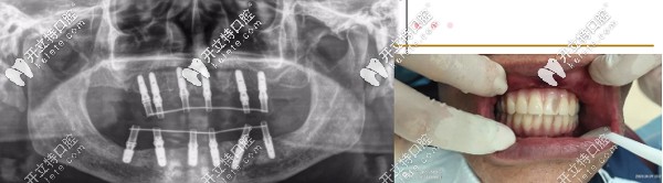 通過ALL-ON-6種植技術(shù)獲滿口好牙 通過ALL-ON-6種植技術(shù)獲滿口好牙