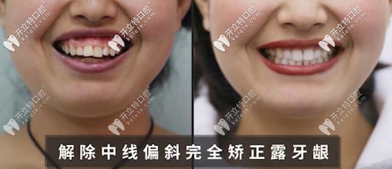 解決了露齦笑額齙牙的問題，小姐姐笑的不要太開心