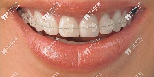 汕頭陶瓷矯正的價(jià)格