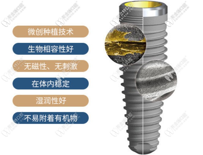 瑞典諾貝爾種植牙一顆多少錢?pmc/cc等幾種型號(hào)的價(jià)格不同哦