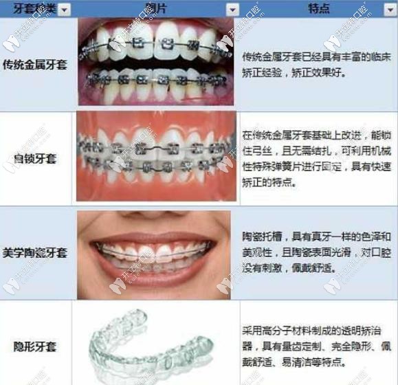 幾款常見牙套的優(yōu)劣勢對比
