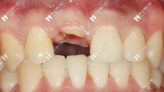 前牙區(qū)應(yīng)用盾構(gòu)術(shù)進(jìn)行即刻種植案例更新,美學(xué)效果更贊！