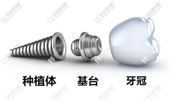 種植牙由種植牙、基臺及牙冠組成