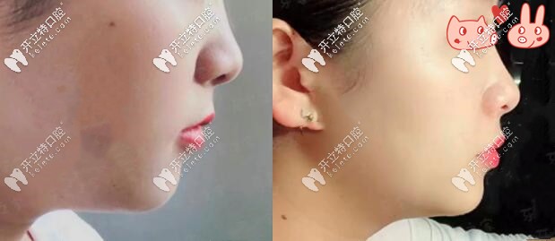 1年后側(cè)面對比圖，效果顯著