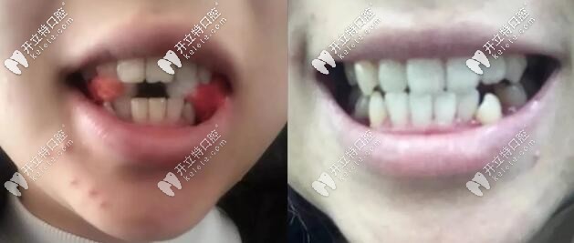 20多歲姑娘牙齒矯正之前的圖片