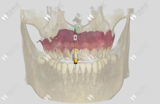 導(dǎo)板種植對于植體的角度和深度調(diào)整