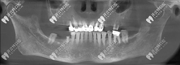 15分鐘種3顆牙的王阿姨感言：德國生長因子種植牙技術(shù)真牛