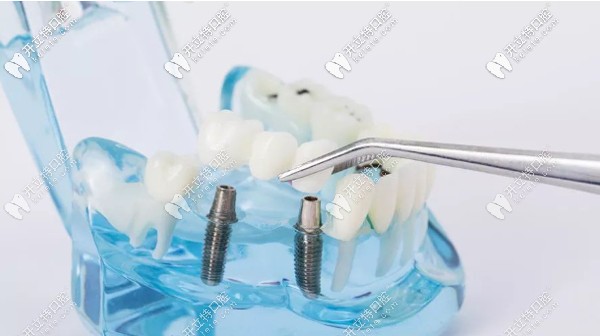 烤瓷牙冠會影響核磁共振診斷