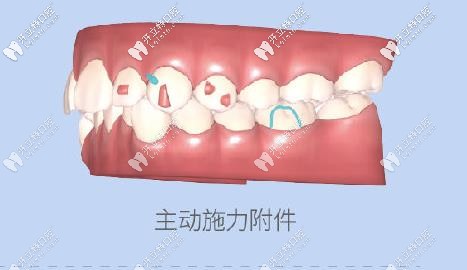 附件會(huì)對牙齒進(jìn)行施力