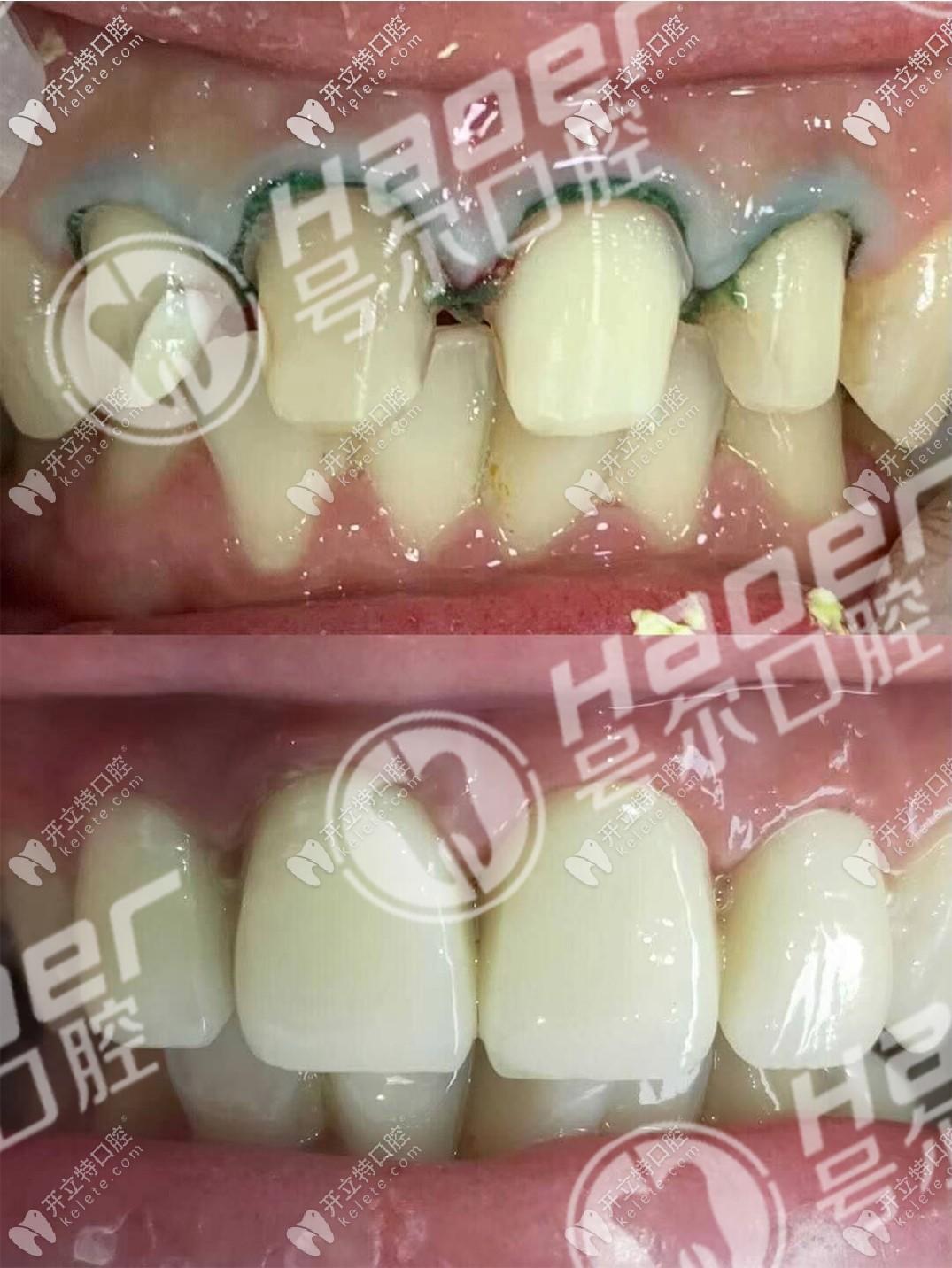 說不痛苦是假的,談?wù)勎铱敬裳烙?年后拆了換全瓷牙過程！