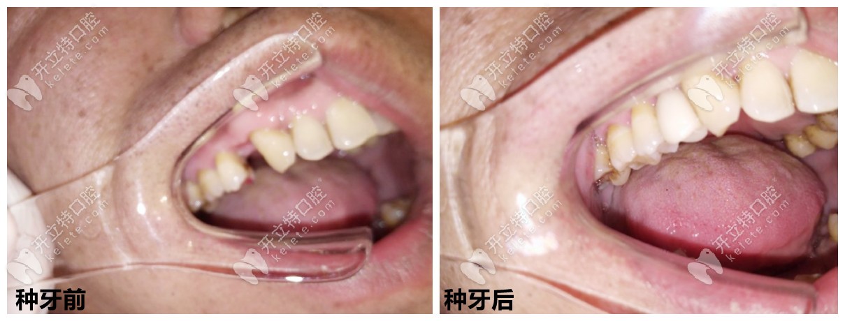 石家莊中諾口腔種牙好嗎？從種牙案例、醫(yī)生技術(shù)來看！