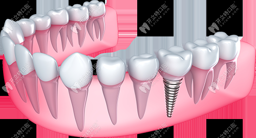 即刻負重種植牙的優(yōu)勢