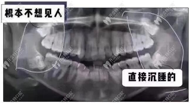 長得很對稱，4顆智齒清潔不到