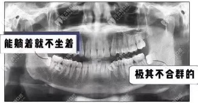 阻生牙、阻生智齒（橫著生長）