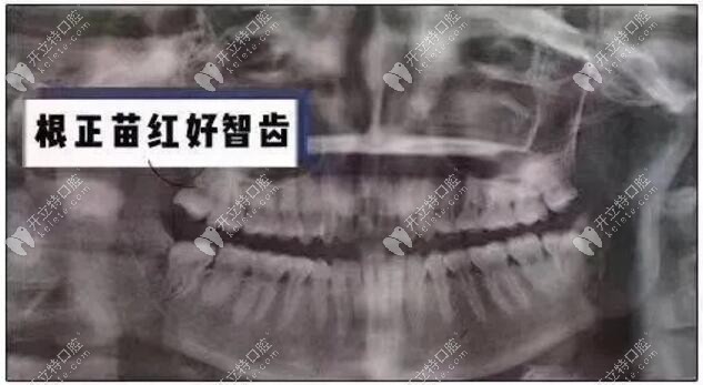 單邊長了1顆智齒牙影響咬合功能